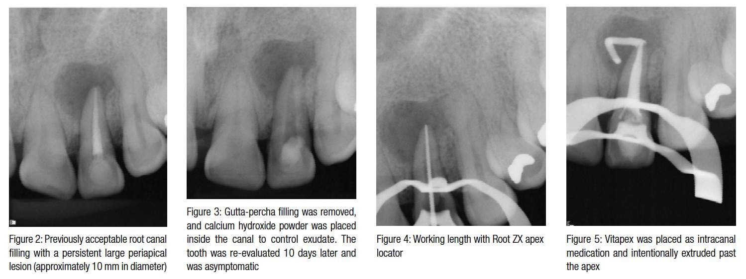 Nonsurgical endodontic retreatment of extensive periapical lesions