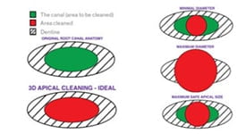 Figure 3: The practitioner is limited in root canal instrumentation by the round shape that the file will produce because of the disparity of shape between the file and the canal/root