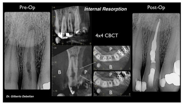 Figure 9: Example case where the action of the finisher can be appreciated because the irregularity in the canal is also in the mesiodistal dimension due to internal resorption