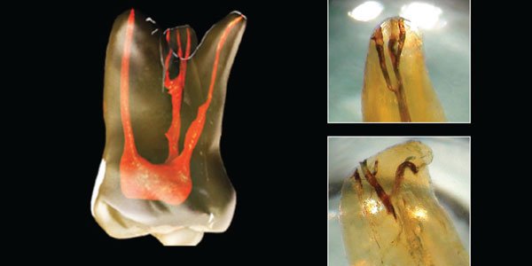 Endodontic irrigation involving the NaOCl component