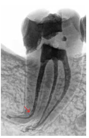 This mandibular right second molar was diagnosed with a large carious lesion invading the pulpal space and irreversible pulpitis with normal periradicual tissue. Post procedure image from GentleWave® root canal therapy1