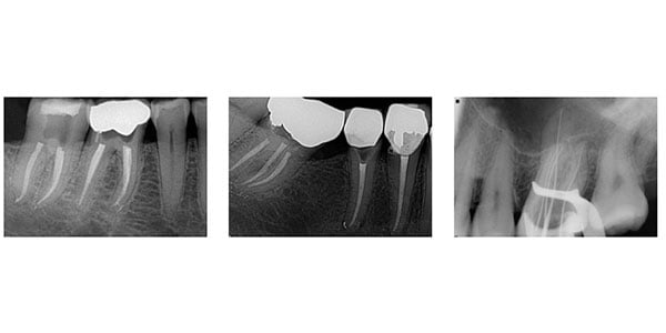 Endo Short Working Length Radiograph Top ten tips: Tip number 7 – To determine length - Endodontic Practice ...