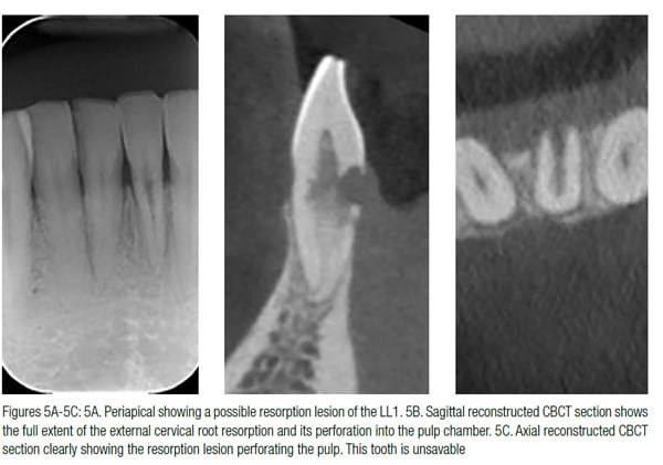 root resorption