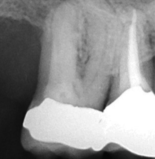 treatment of a maxillary second molar endodontic practice us maxillary second molar